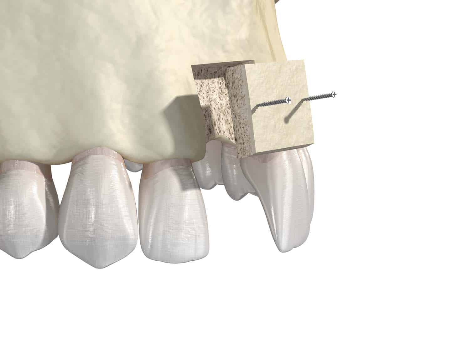 Bone Grafting Procedure Atlanta GA