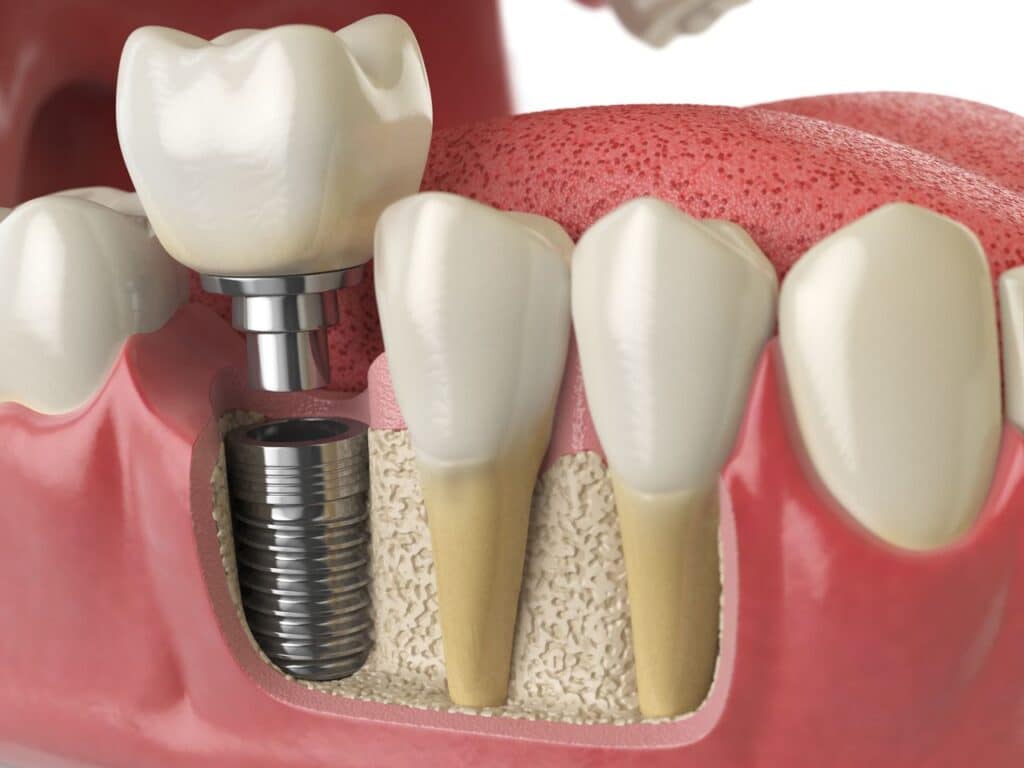 Illustration of a dental implant